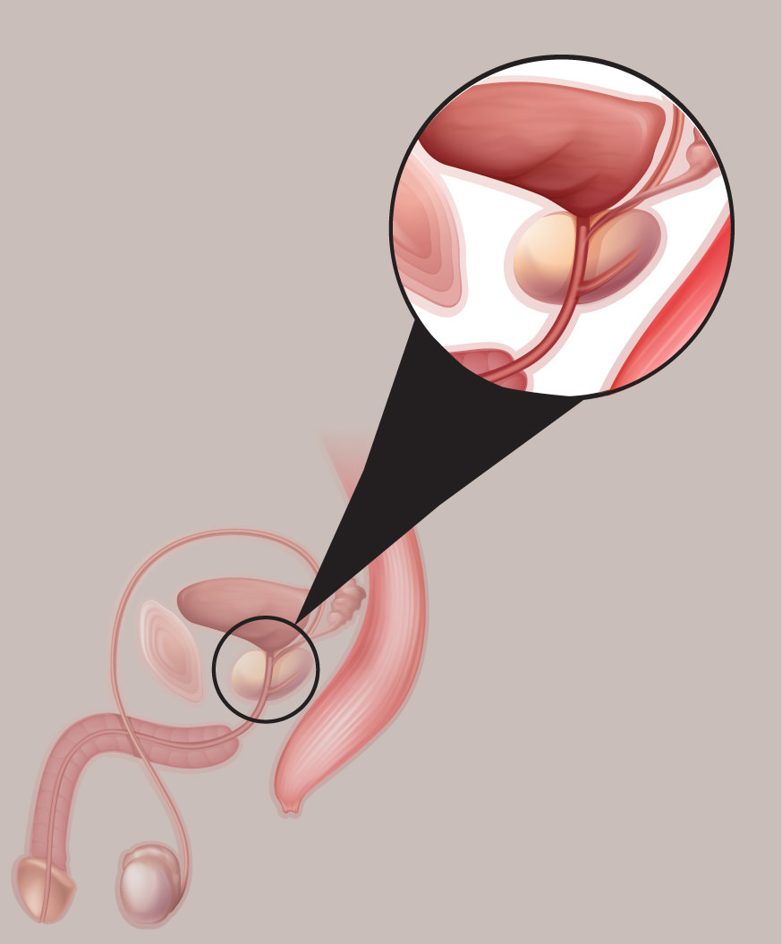 prostata prostata